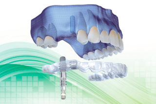 Implantes Straumann